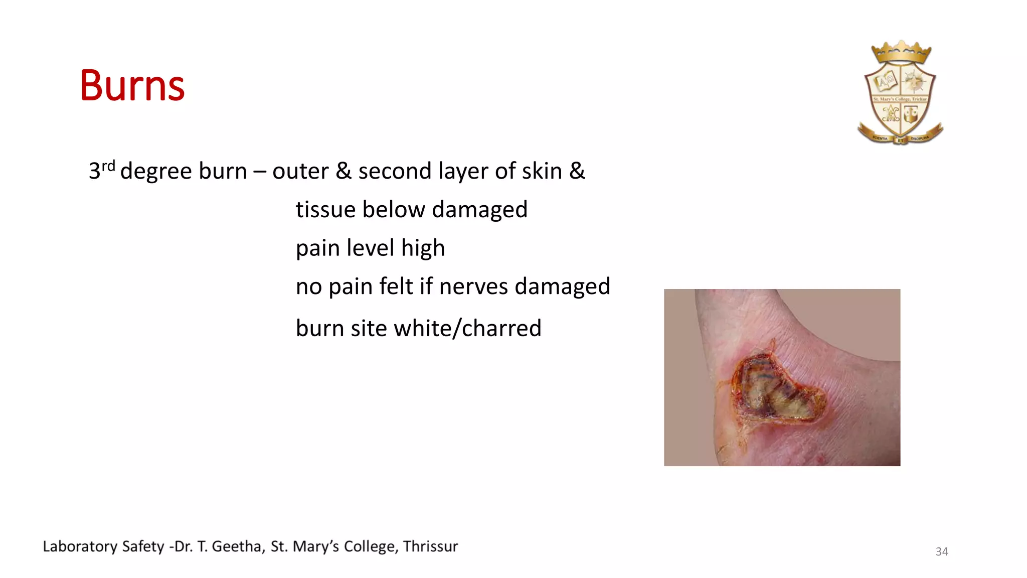Burns
3rd degree burn – outer & second layer of skin &
tissue below damaged
pain level high
no pain felt if nerves damaged
burn site white/charred
34
 
