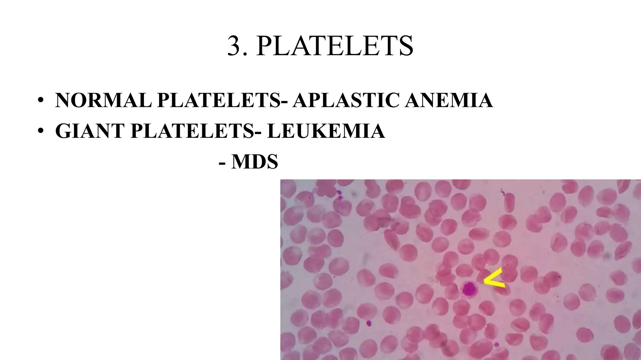 Laboratory investigations in pancytopenia PPTX Laboratory investigations in pancytopenia PPTX