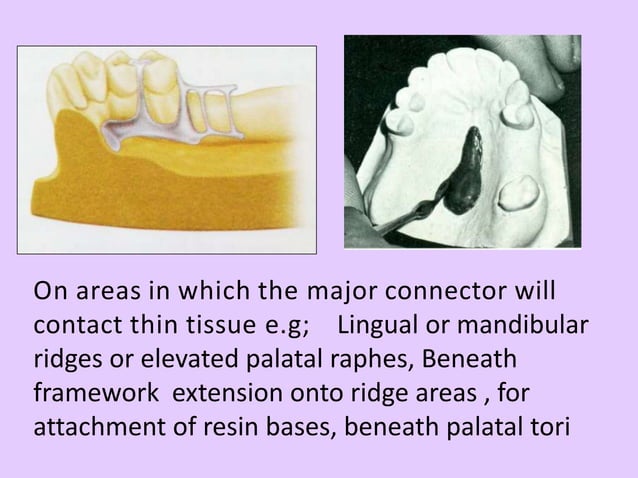 Laboratory procedure in rpd fabrication | PPTX | Dental Health ...