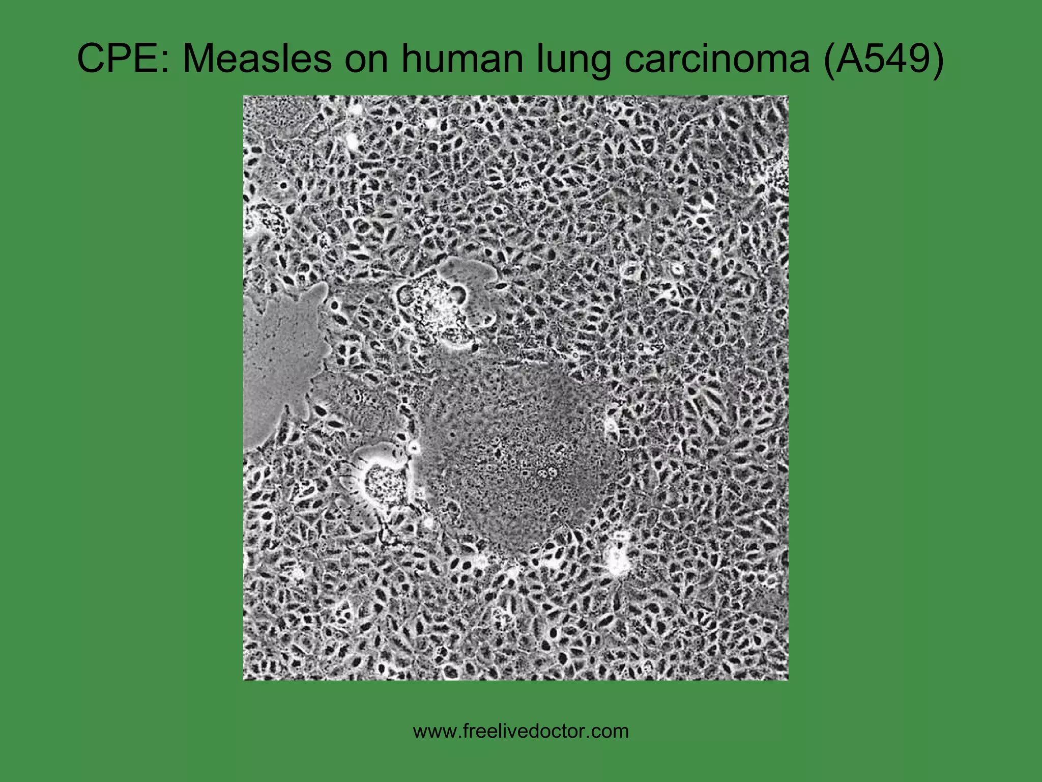 CPE: Measles on human lung carcinoma (A549) www.freelivedoctor.com 