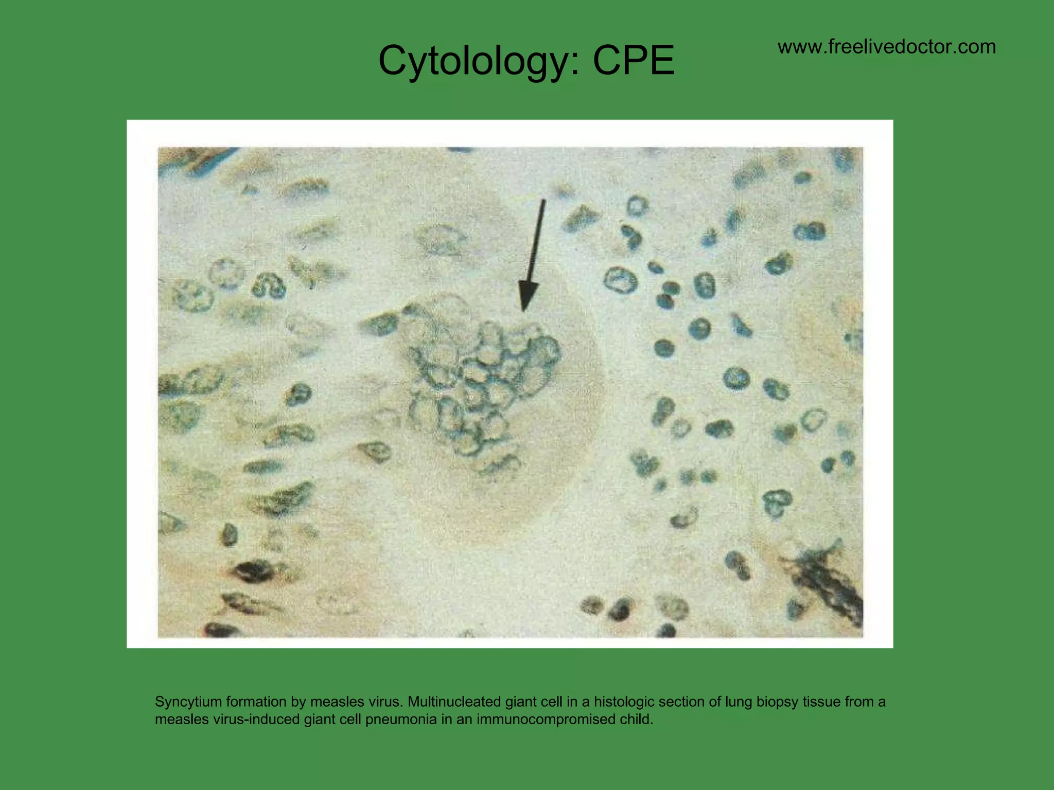 Syncytium formation by measles virus. Multinucleated giant cell in a histologic section of lung biopsy tissue from a measles virus-induced giant cell pneumonia in an immunocompromised child.  Cytolology: CPE www.freelivedoctor.com 