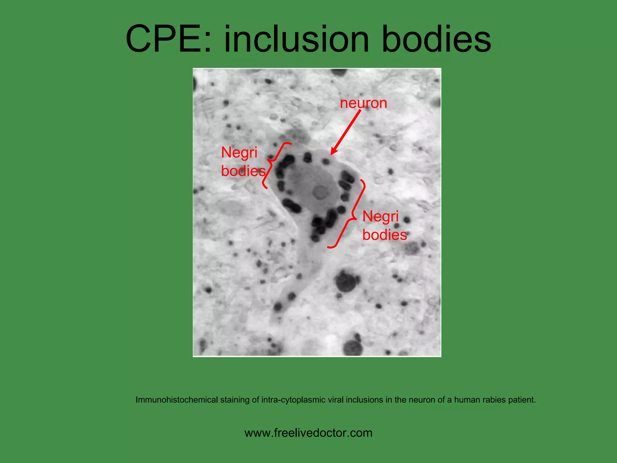 CPE: inclusion bodies Immunohistochemical staining of intra-cytoplasmic viral inclusions in the neuron of a human rabies patient.  www.freelivedoctor.com Negri bodies Negri bodies neuron 