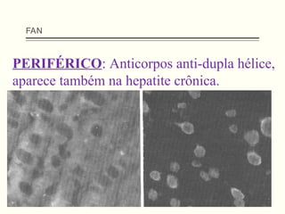 FAN
PERIFÉRICO: Anticorpos anti-dupla hélice,
aparece também na hepatite crônica.
 