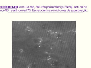 NUCLEOLAR: Anti-u3-rnp, anti-rnapolimerasei(4-6srna), anti-scl70,
nor-90 eanti-pm-scl70. Esclerodermiaesíndromesdesuperposição.
 