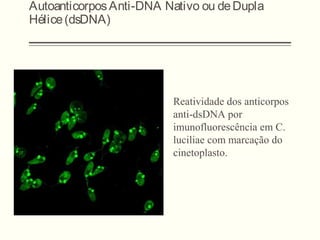 AutoanticorposAnti-DNA Nativo ou deDupla
Hélice(dsDNA)
Reatividade dos anticorpos
anti-dsDNA por
imunofluorescência em C.
luciliae com marcação do
cinetoplasto.
 