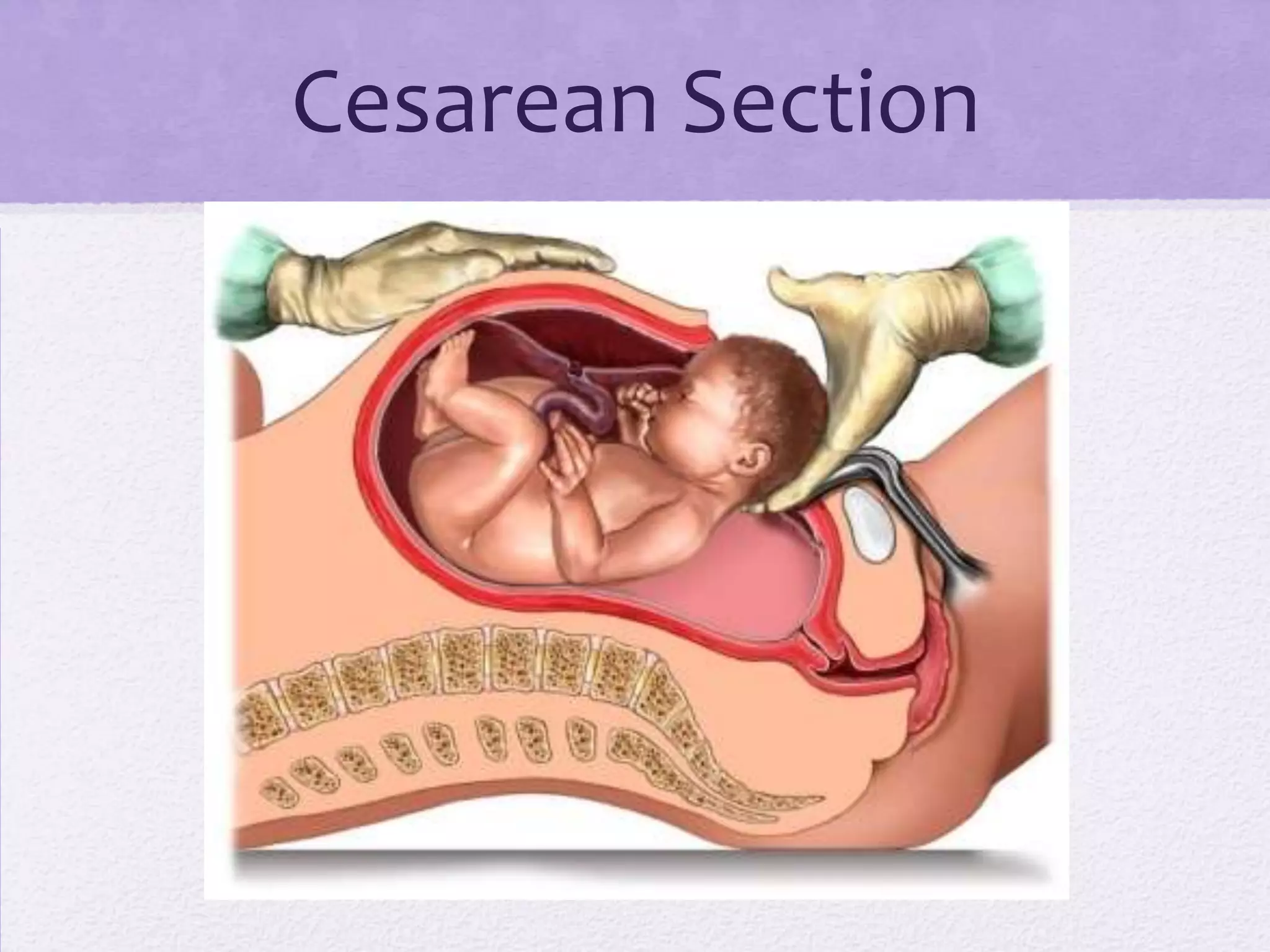 Cesarean Section