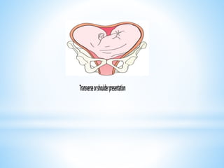 Transverseorshoulderpresentation
 
