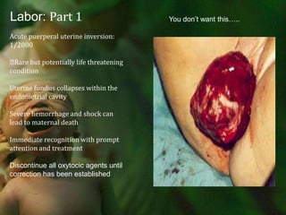 Labor: Part 1The three classic signs of placental separation will be:Lengthening of the umbilical cordA gush of blood from the vagina signifying the separation of the placenta from the uterine wallA change in the shape of the uterine fundus from discoid to globular, with an elevation of fundal heightUterotonics given after delivery of the fetus (active management can hasten the delivery of the placenta, reduce blood loss and improve uterine contractilityBe Patient……………