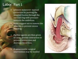 Labor: Part 1You don’t want this…..Acute puerperal uterine inversion:  1/2000Rare but potentially life threatening conditionUterine fundus collapses within the endometrial cavity