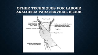 OTHER TECHNIQUES FOR LABOUR 
ANALGESIA:PARACERVICAL BLOCK 
 