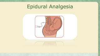 Epidural Analgesia
 