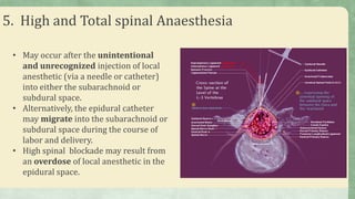 5. High and Total spinal Anaesthesia
• May occur after the unintentional
and unrecognized injection of local
anesthetic (via a needle or catheter)
into either the subarachnoid or
subdural space.
• Alternatively, the epidural catheter
may migrate into the subarachnoid or
subdural space during the course of
labor and delivery.
• High spinal blockade may result from
an overdose of local anesthetic in the
epidural space.
 