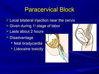 Paracervical Block
 Local bilateral injection near the cervix
 Given during 1st stage of labor
 Lasts about 2 hours
 Disadvantage
 fetal bradycardia
 Lidocaine toxicity

 