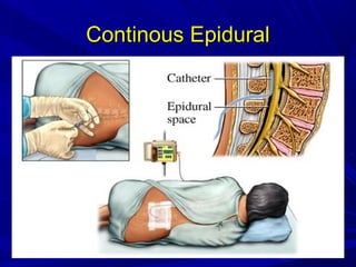 Continous Epidural

 