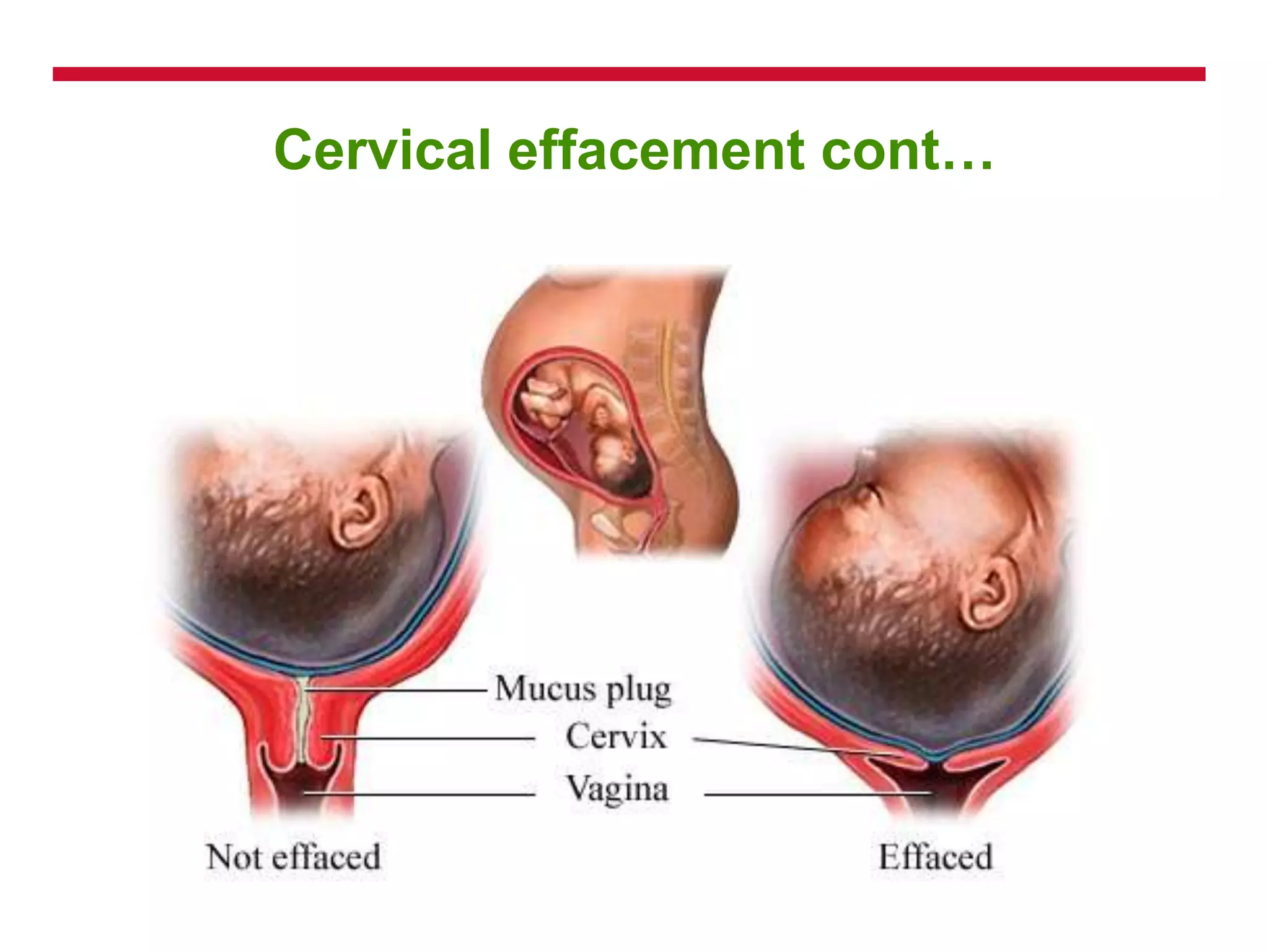 Cervical effacement cont…
 