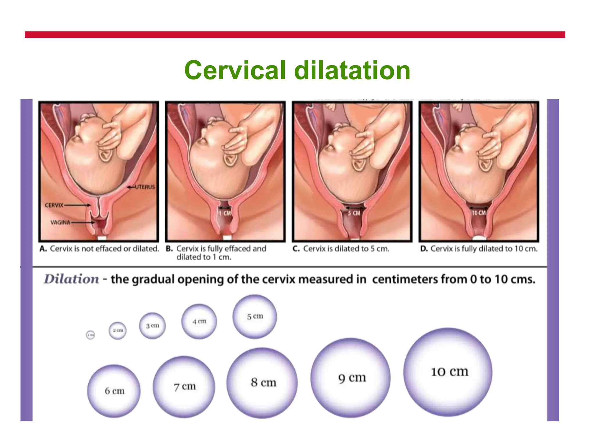 Cervical dilatation
 