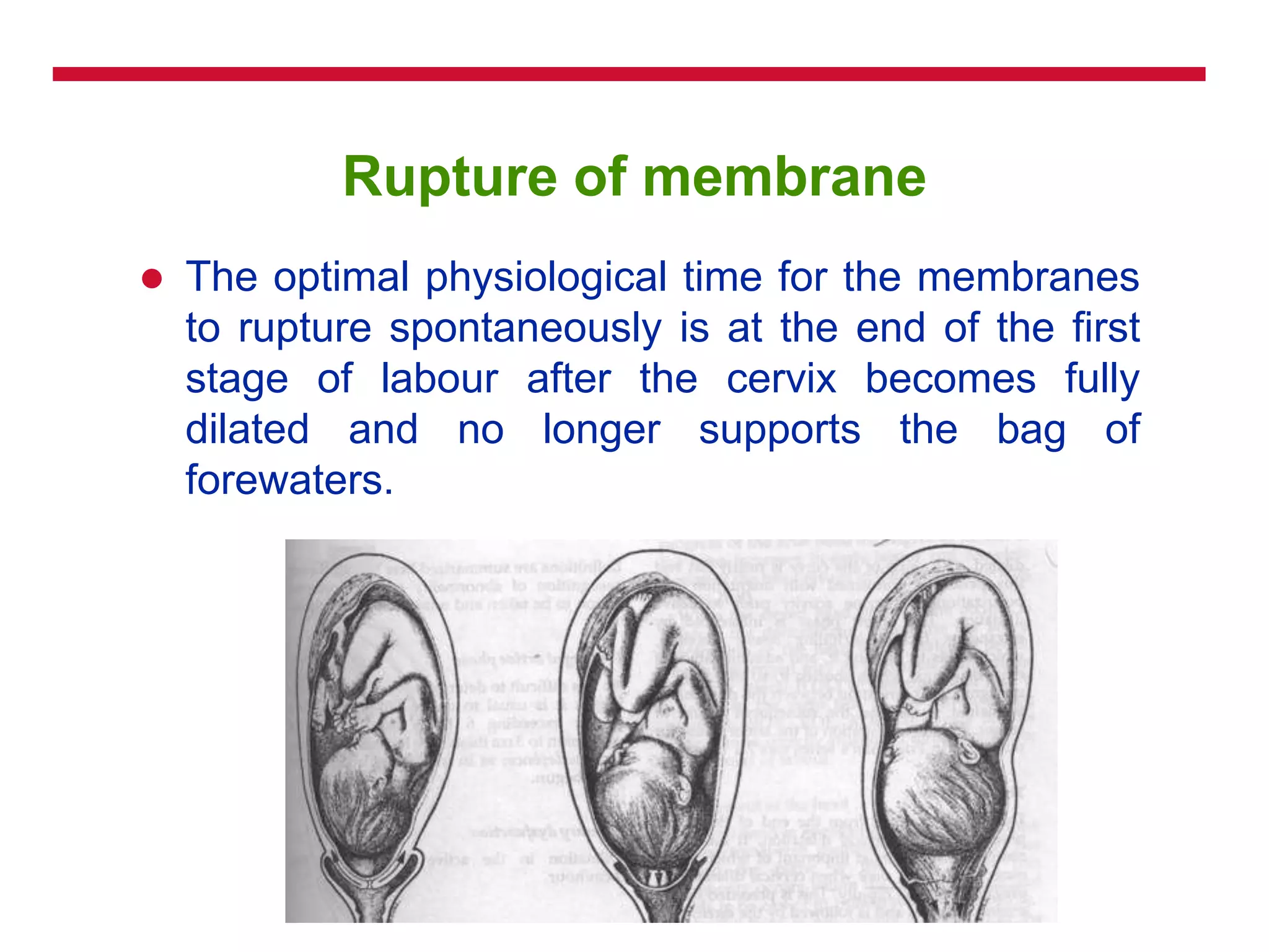 Rupture of membrane
 The optimal physiological time for the membranes
to rupture spontaneously is at the end of the first
stage of labour after the cervix becomes fully
dilated and no longer supports the bag of
forewaters.
 