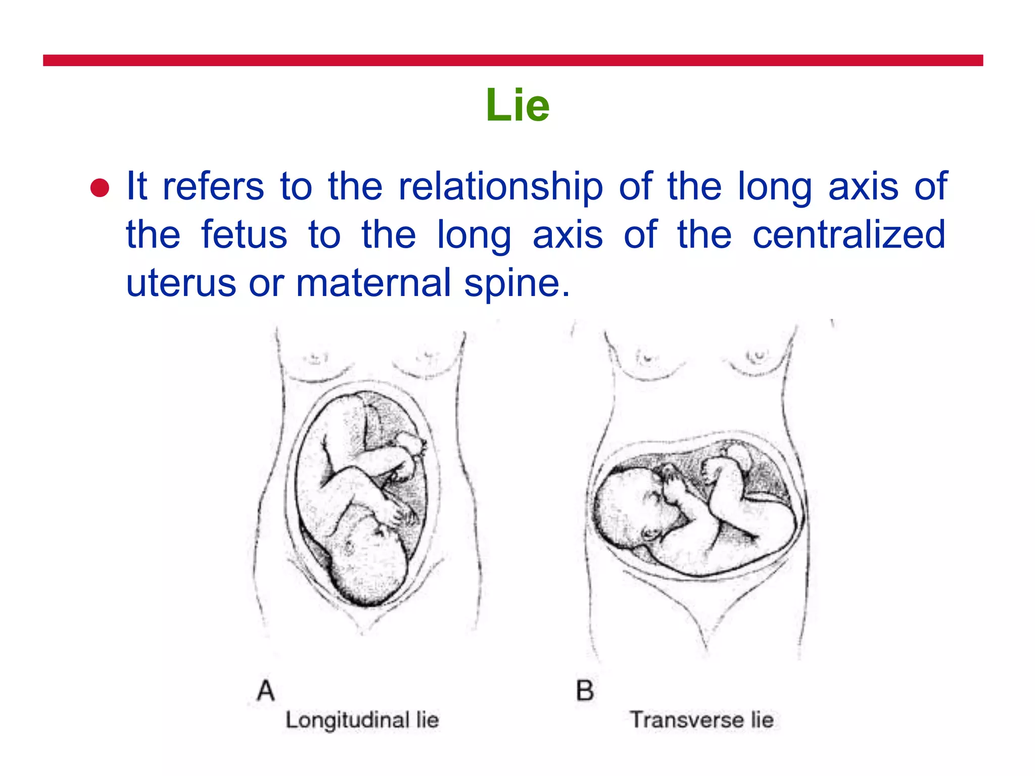 Lie
 It refers to the relationship of the long axis of
the fetus to the long axis of the centralized
uterus or maternal spine.
 