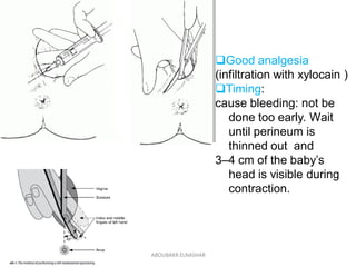 Good analgesia
(infiltration with xylocain )
Timing:
cause bleeding: not be
done too early. Wait
until perineum is
thinn...