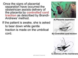 Once the signs of placental
separation have occurred the
obstetrician assists delivery of
the placenta by controlled cord
...