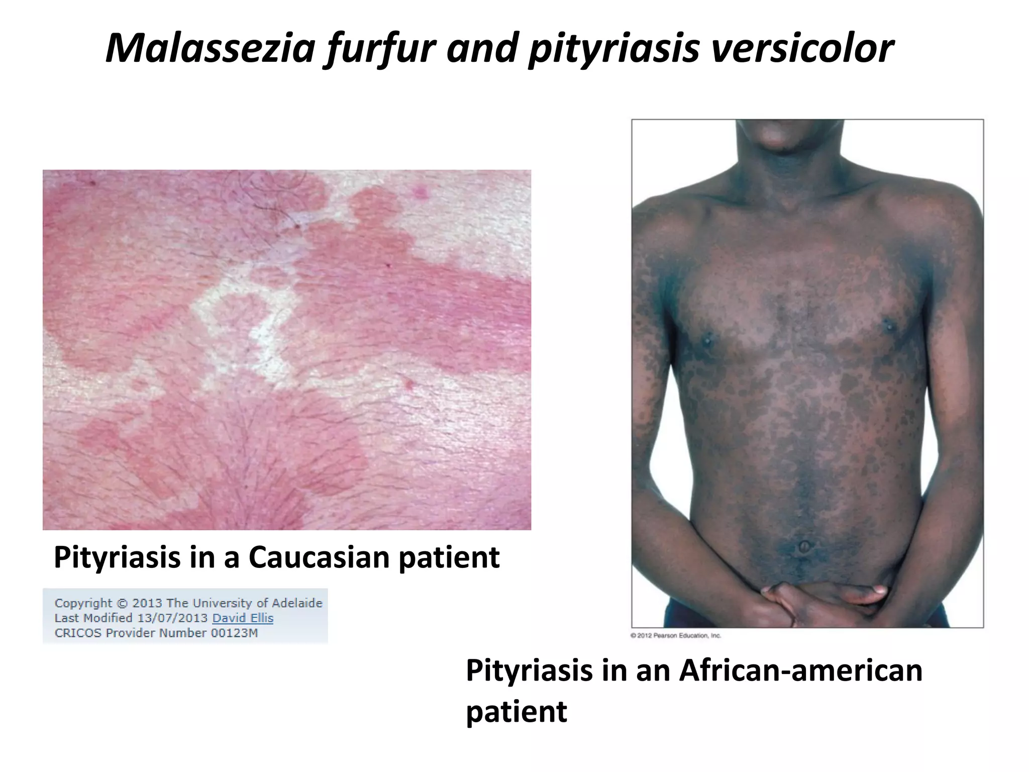 Pityriasis in a Caucasian patient
Pityriasis in an African-american
patient
Malassezia furfur and pityriasis versicolor
 