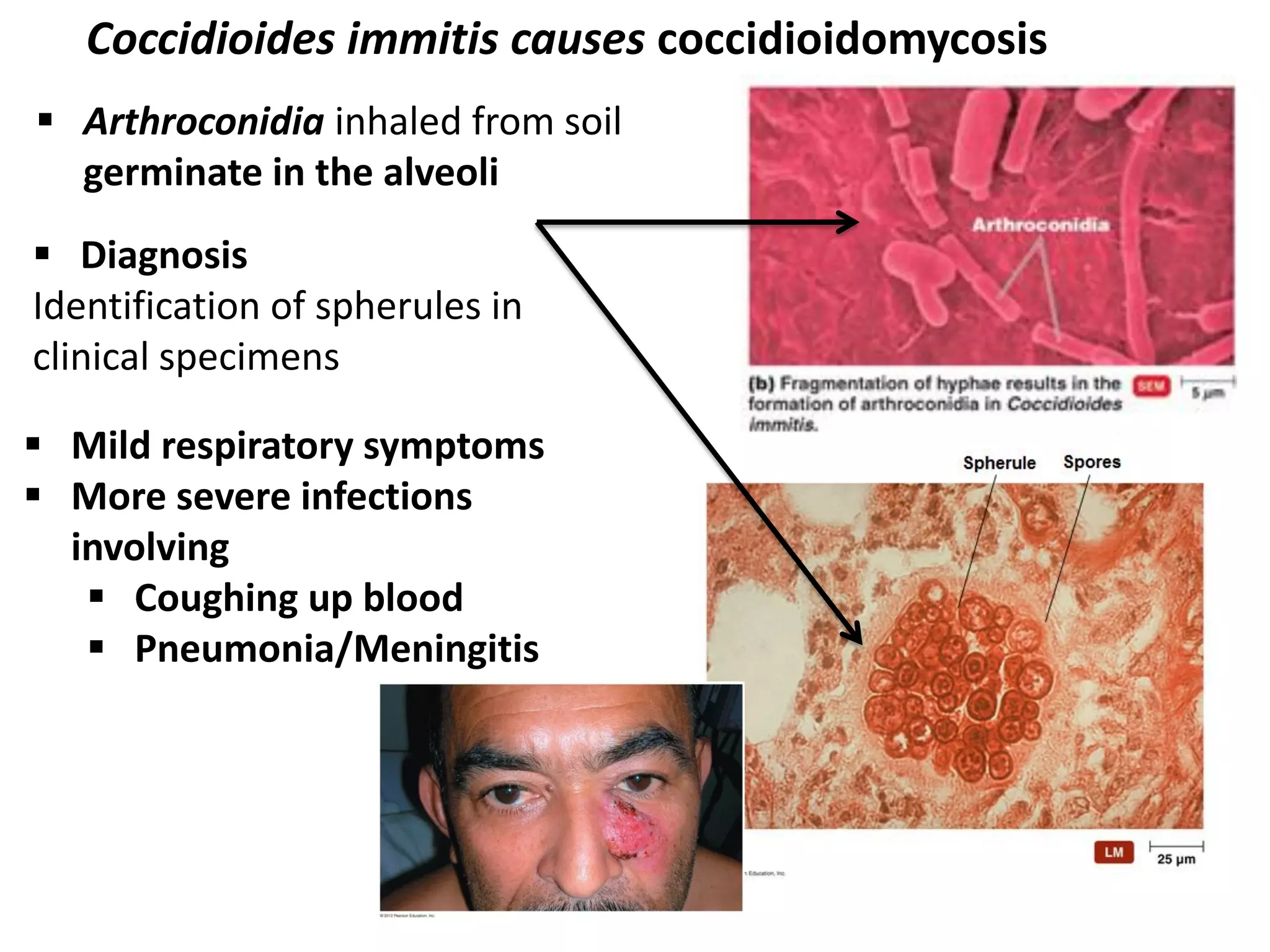  Arthroconidia inhaled from soil
germinate in the alveoli
Coccidioides immitis causes coccidioidomycosis
 Diagnosis
Identification of spherules in
clinical specimens
 Mild respiratory symptoms
 More severe infections
involving
 Coughing up blood
 Pneumonia/Meningitis
 