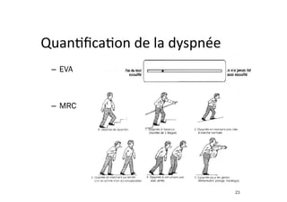 QuanFﬁcaFon	
  de	
  la	
  dyspnée	
  
–  EVA
–  MRC
23
 
