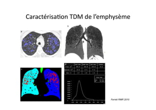 CaractérisaFon	
  TDM	
  de	
  l’emphysème	
  
Ferreti RMR 2010
 