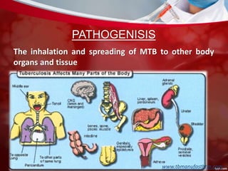 PATHOGENISIS
The inhalation and spreading of MTB to other body
organs and tissue
www.tbmanufasthtm.com
 