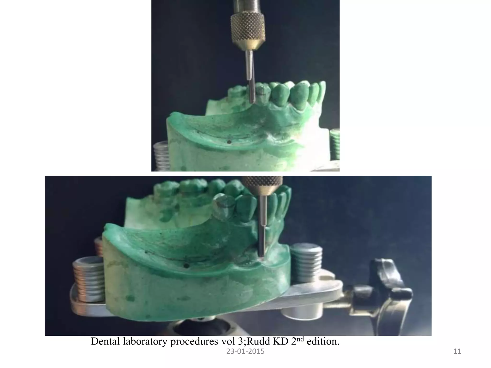 23-01-2015 11
Dental laboratory procedures vol 3;Rudd KD 2nd edition.
 
