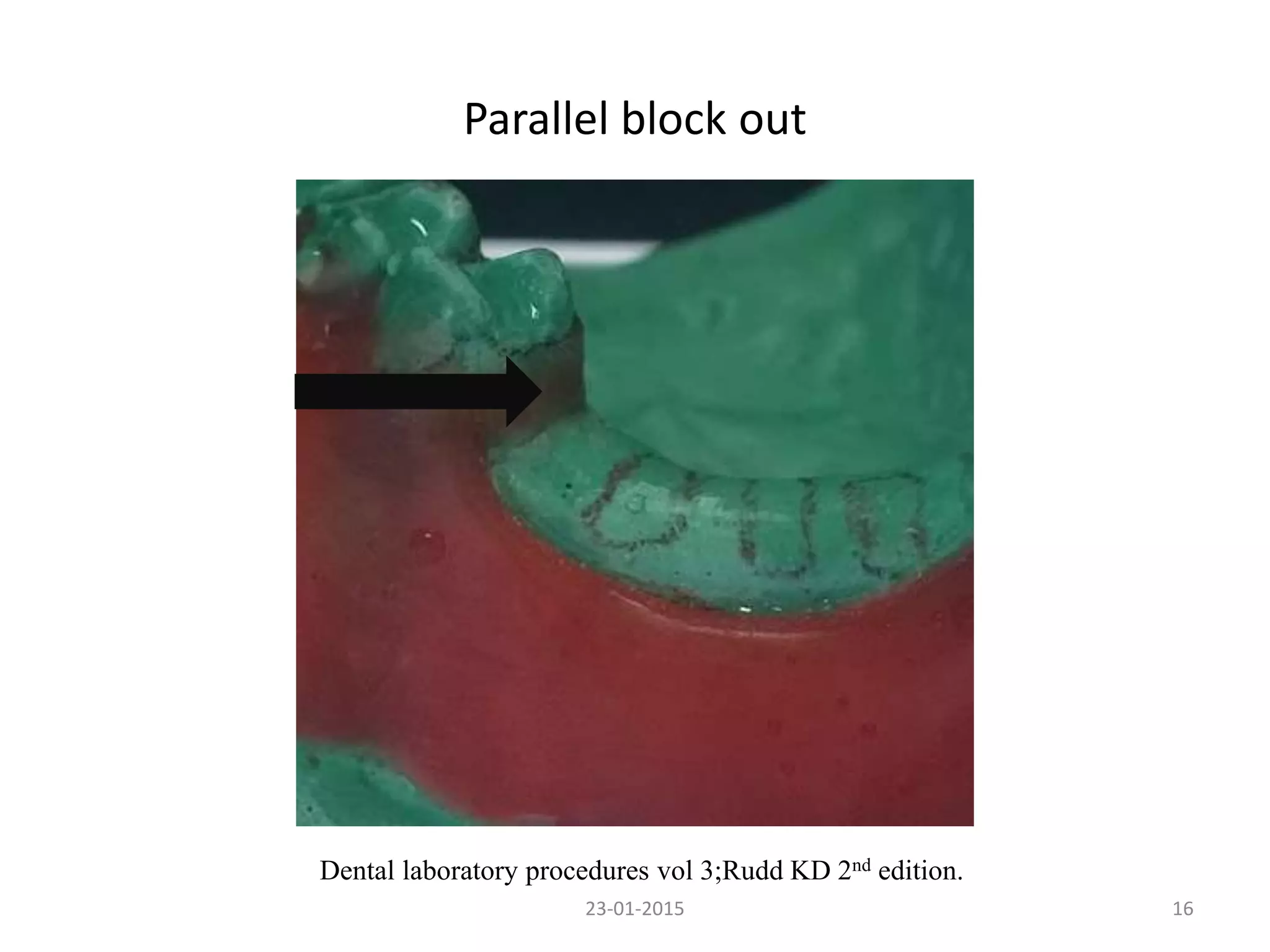 Parallel block out
1623-01-2015
Dental laboratory procedures vol 3;Rudd KD 2nd edition.
 