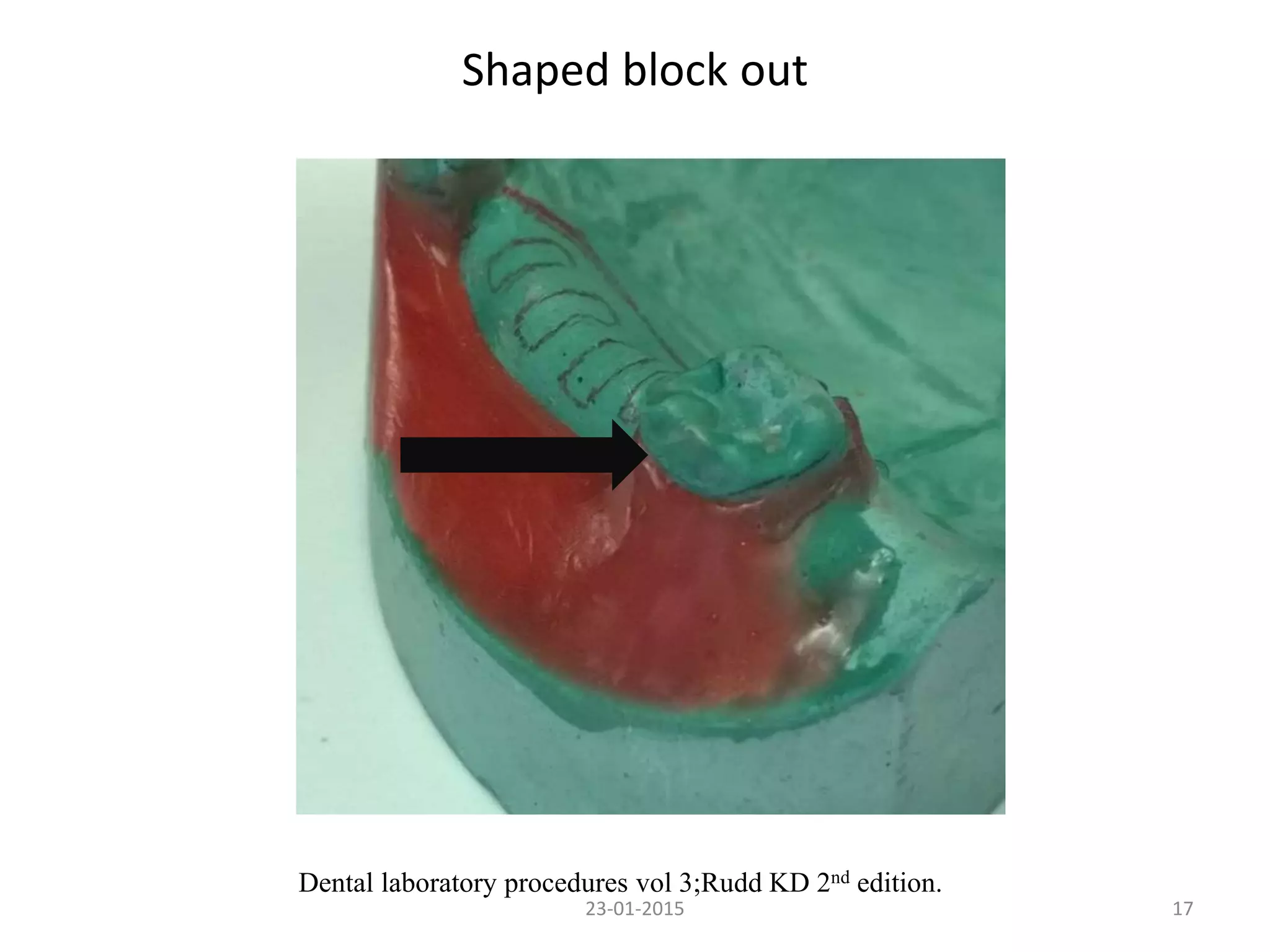 Shaped block out
1723-01-2015
Dental laboratory procedures vol 3;Rudd KD 2nd edition.
 