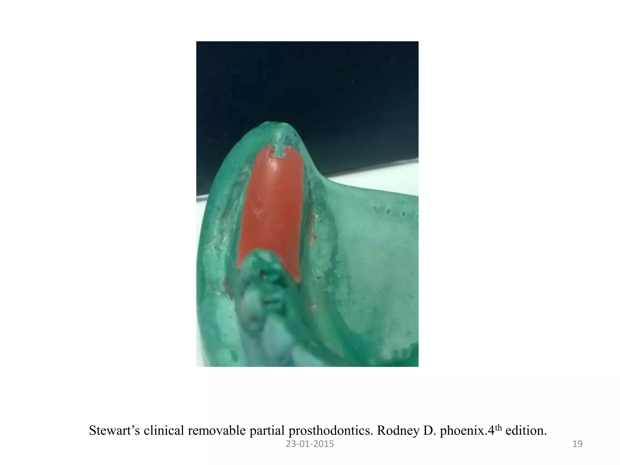 23-01-2015 19
Stewart’s clinical removable partial prosthodontics. Rodney D. phoenix.4th edition.
 