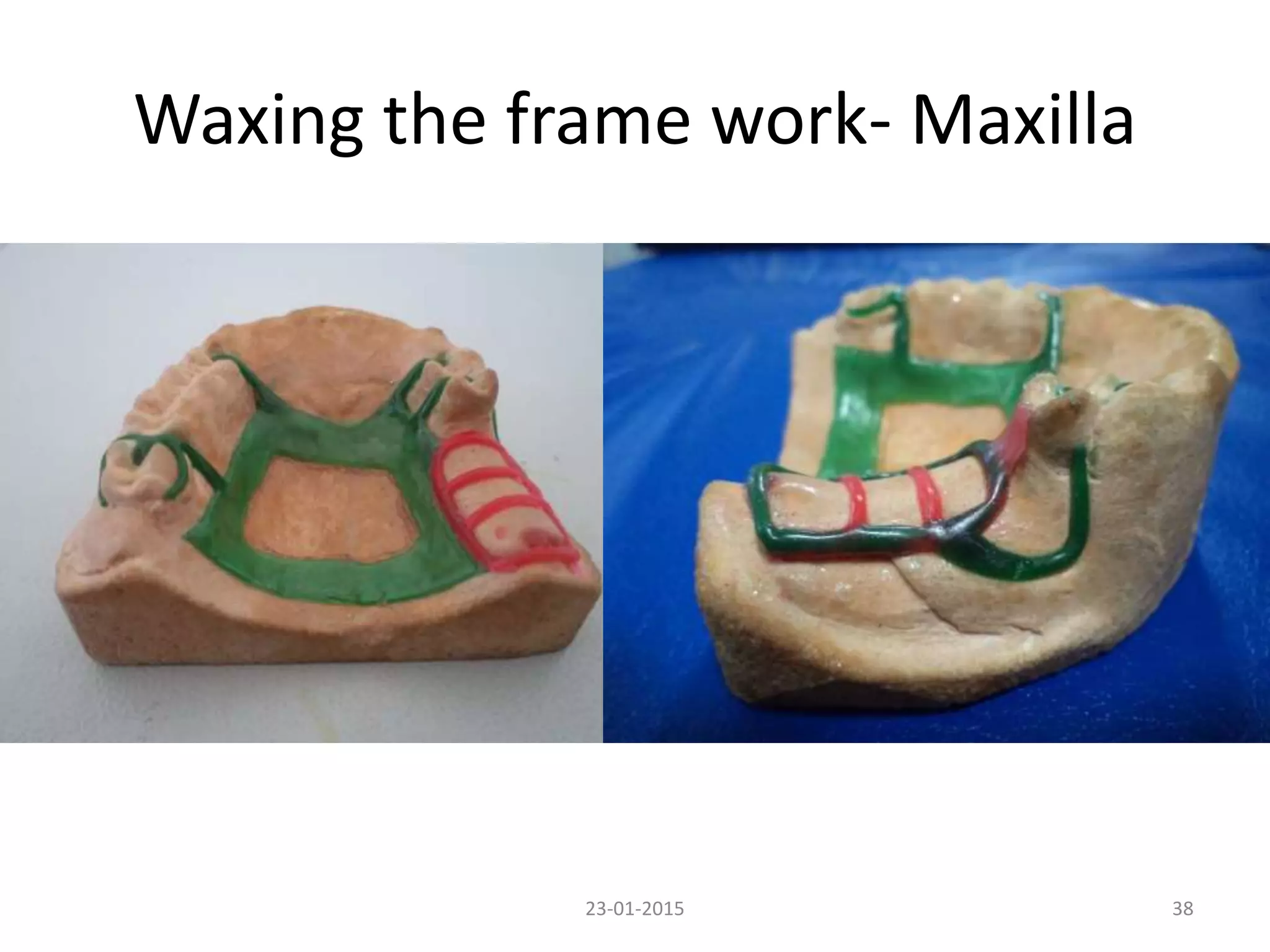 Waxing the frame work- Maxilla
3823-01-2015
 