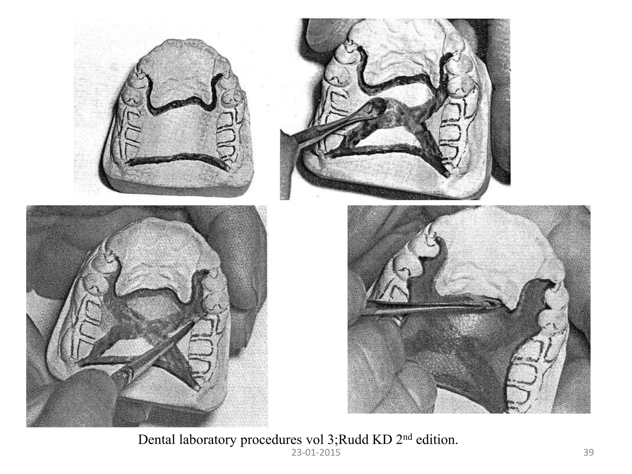 3923-01-2015
Dental laboratory procedures vol 3;Rudd KD 2nd edition.
 