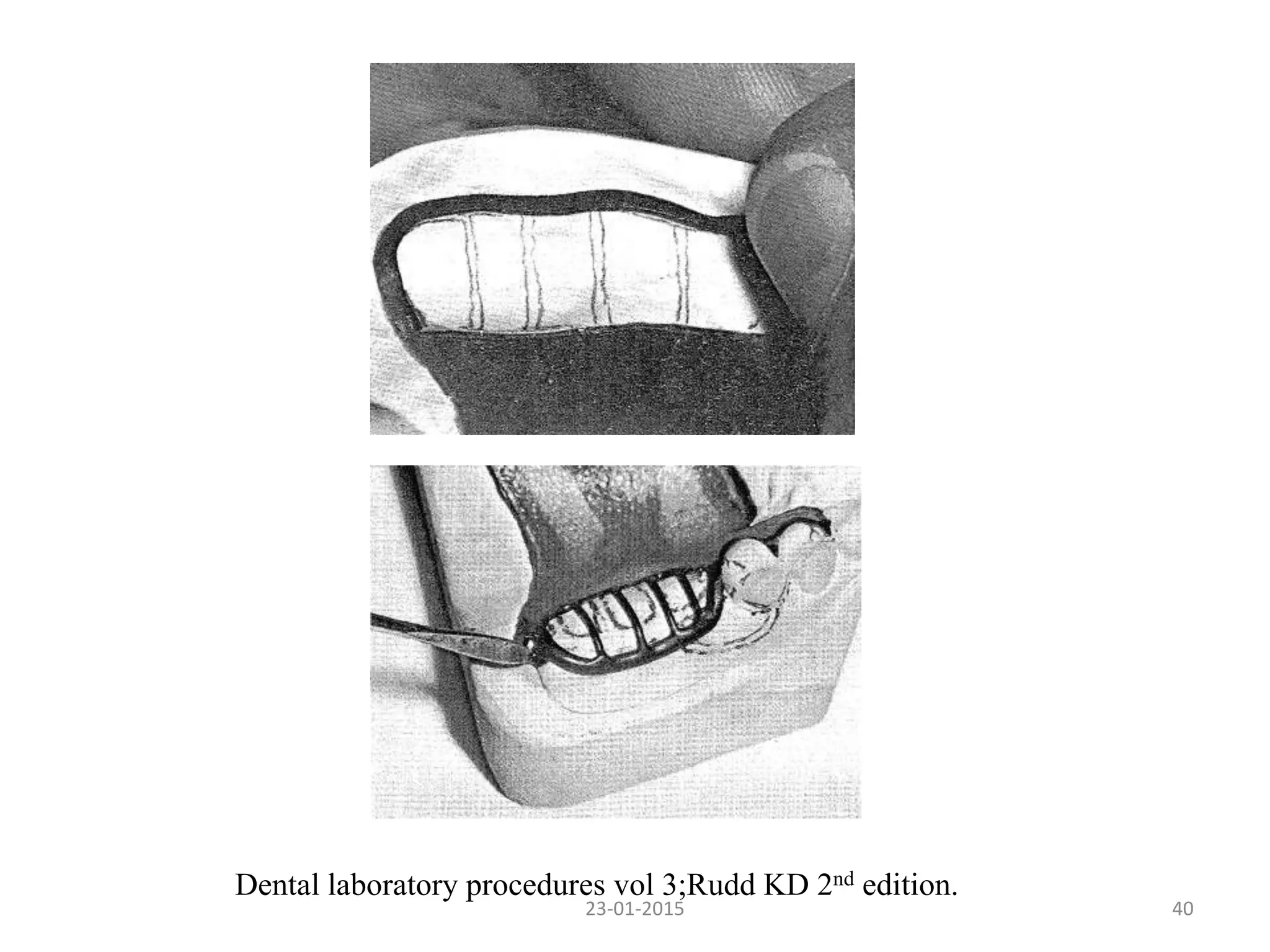 4023-01-2015
Dental laboratory procedures vol 3;Rudd KD 2nd edition.
 