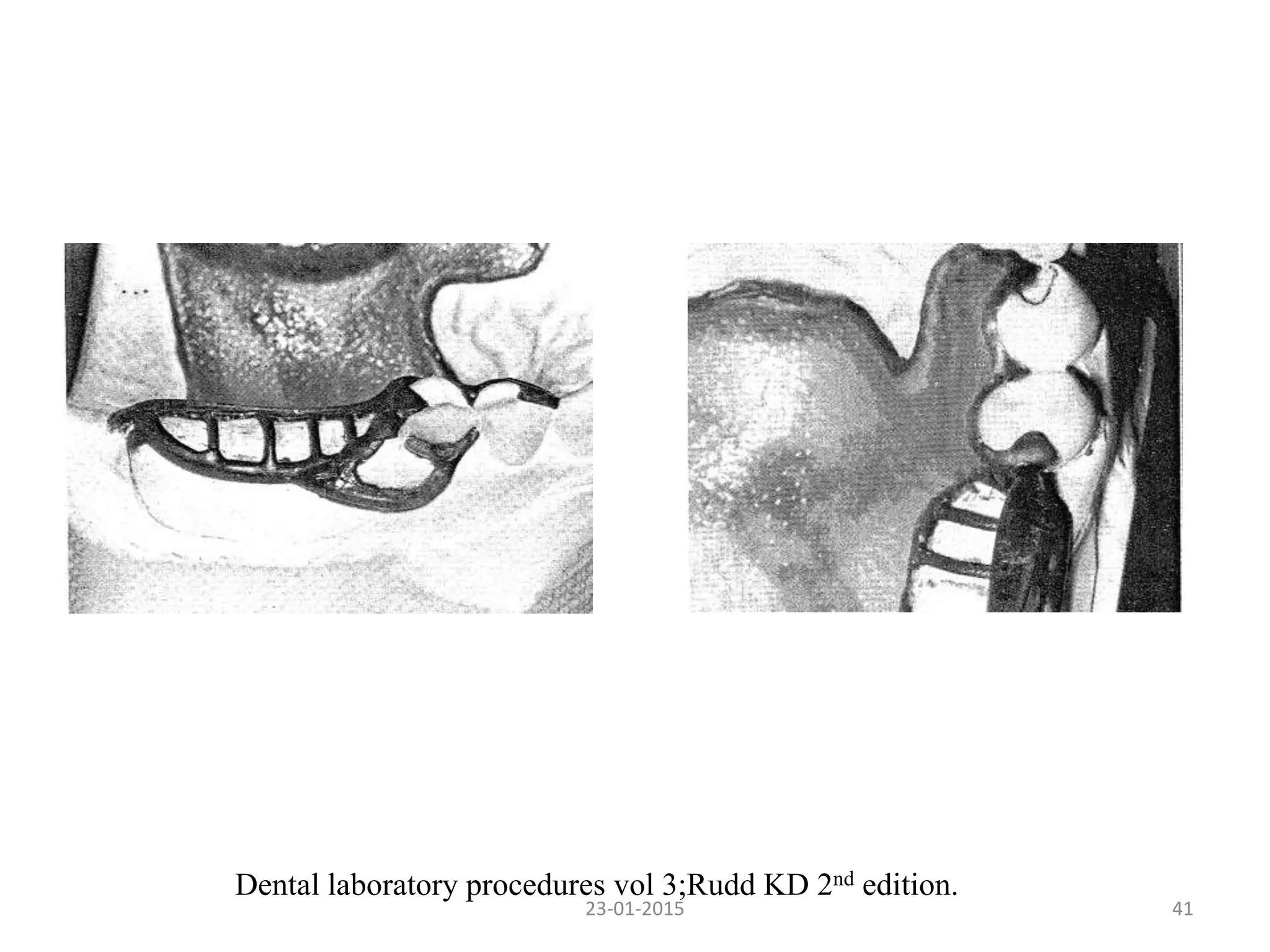 4123-01-2015
Dental laboratory procedures vol 3;Rudd KD 2nd edition.
 