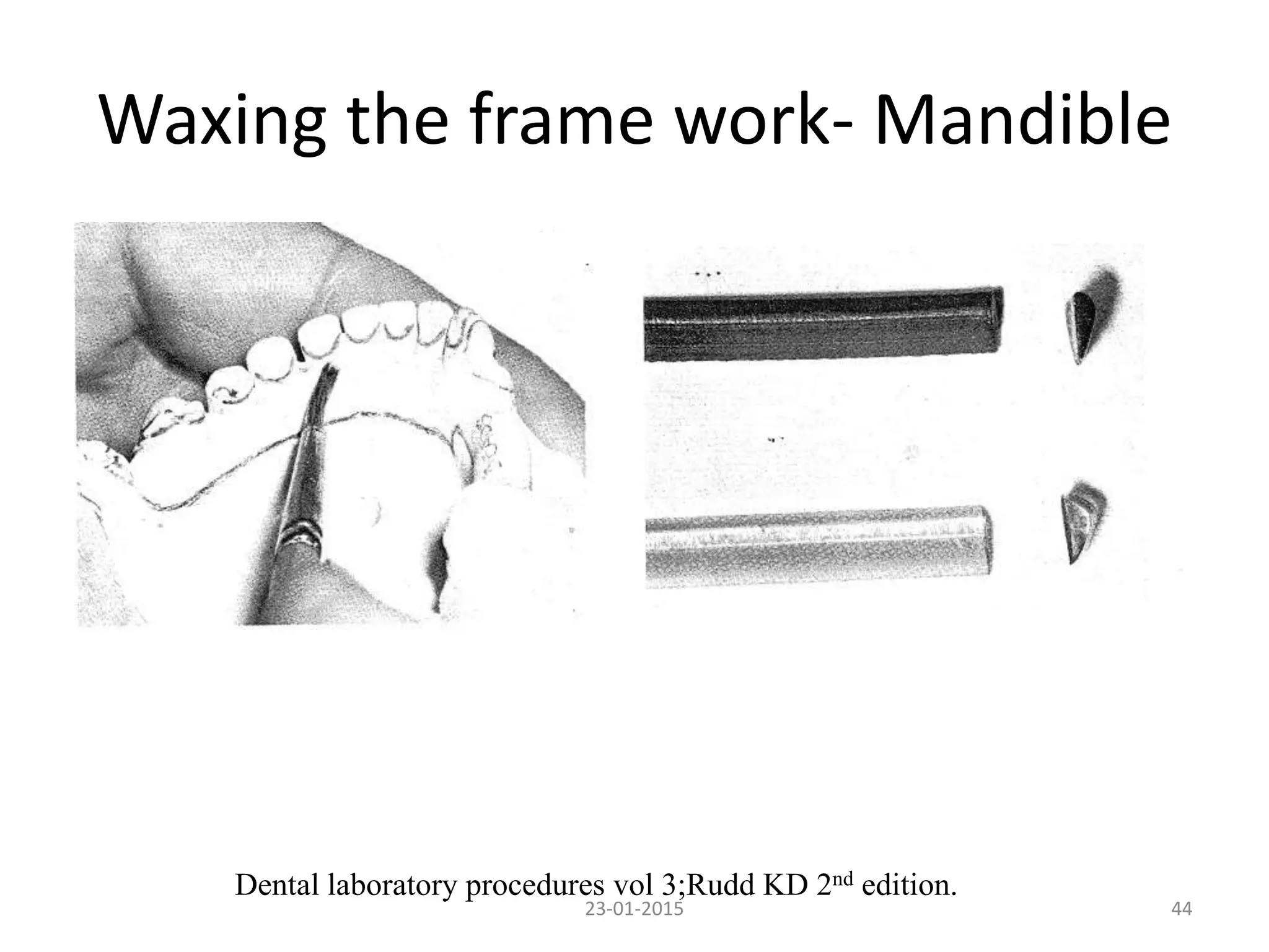 Waxing the frame work- Mandible
4423-01-2015
Dental laboratory procedures vol 3;Rudd KD 2nd edition.
 