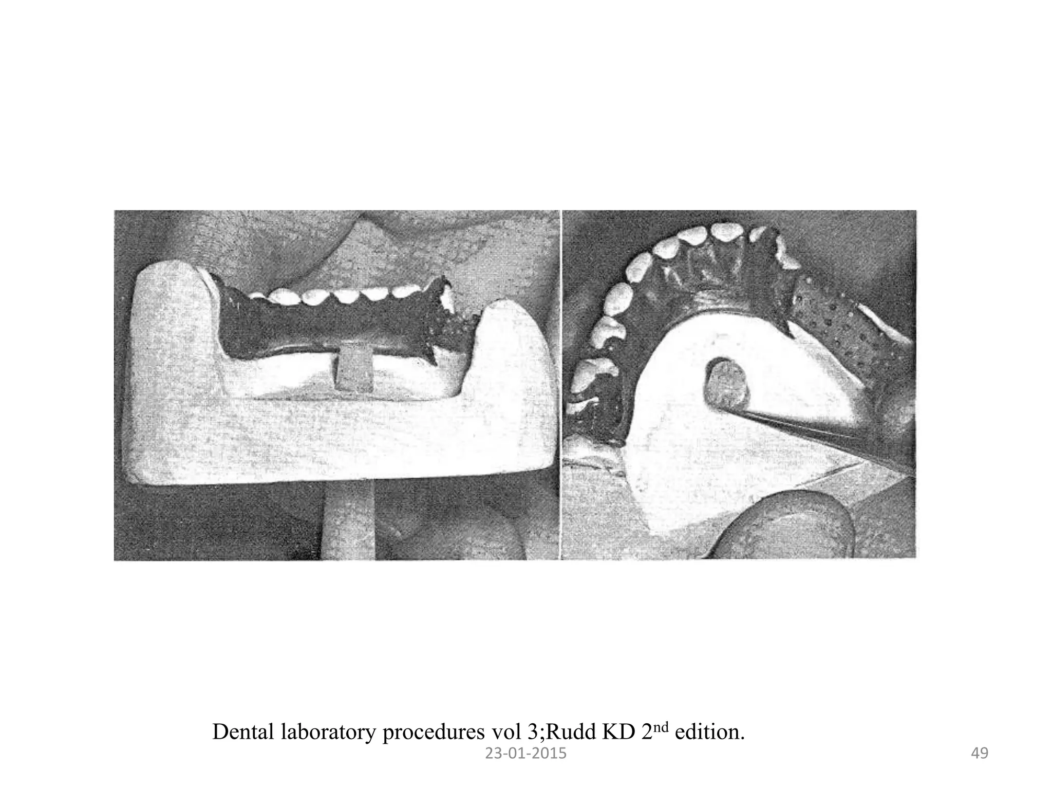 4923-01-2015
Dental laboratory procedures vol 3;Rudd KD 2nd edition.
 
