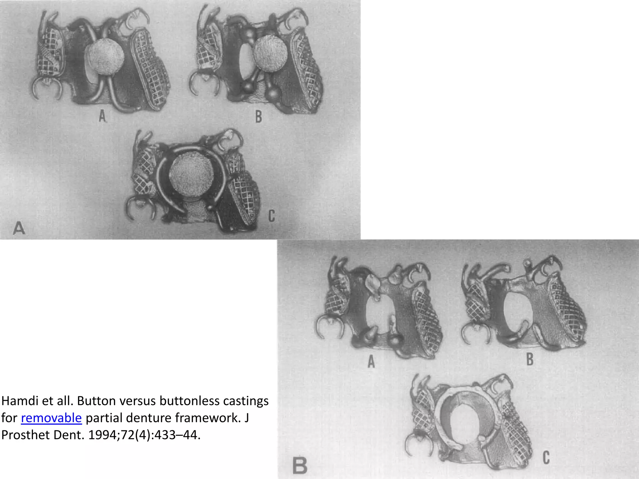 5223-01-2015
Hamdi et all. Button versus buttonless castings
for removable partial denture framework. J
Prosthet Dent. 1994;72(4):433–44.
 