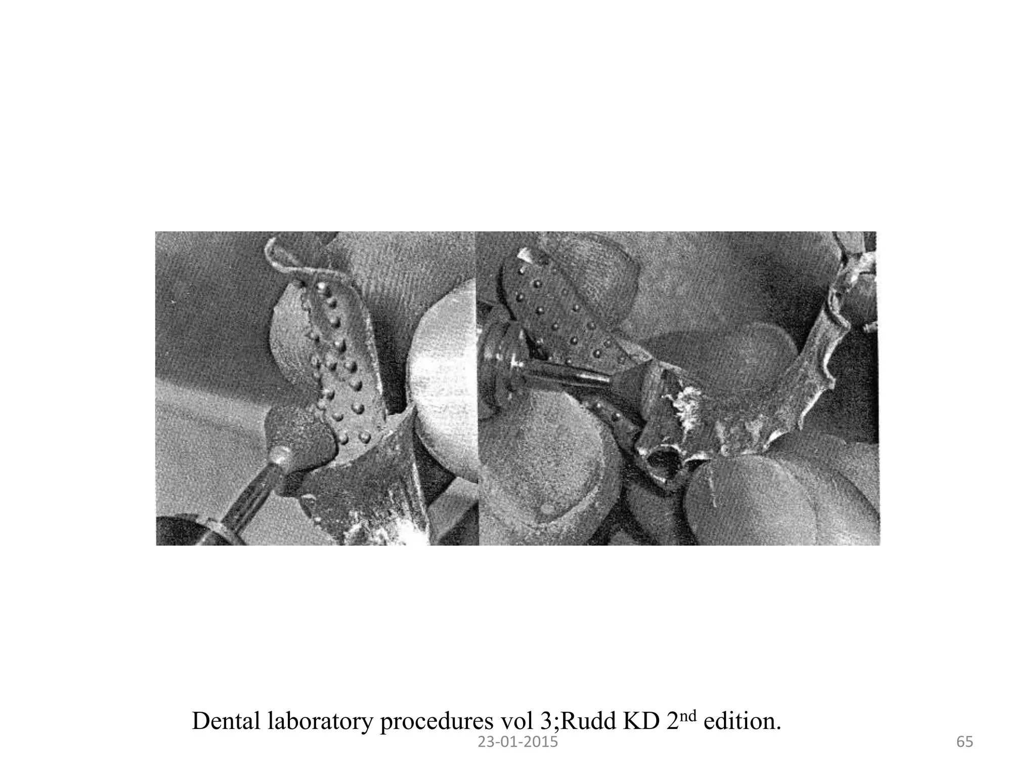 6523-01-2015
Dental laboratory procedures vol 3;Rudd KD 2nd edition.
 