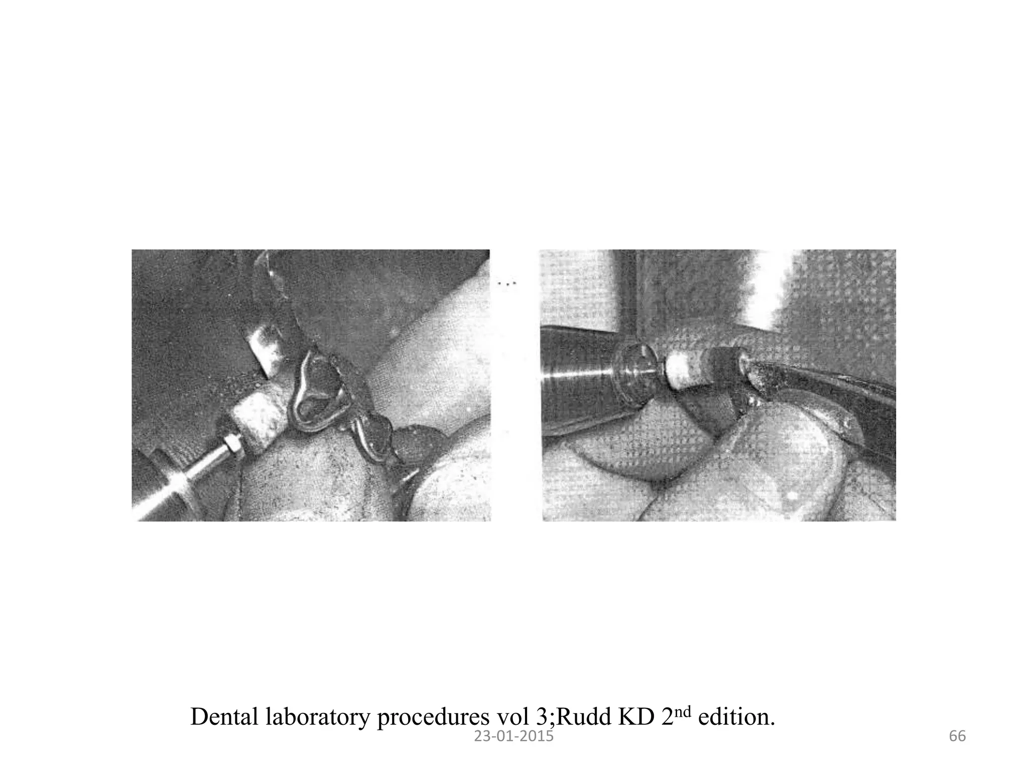 6623-01-2015
Dental laboratory procedures vol 3;Rudd KD 2nd edition.
 