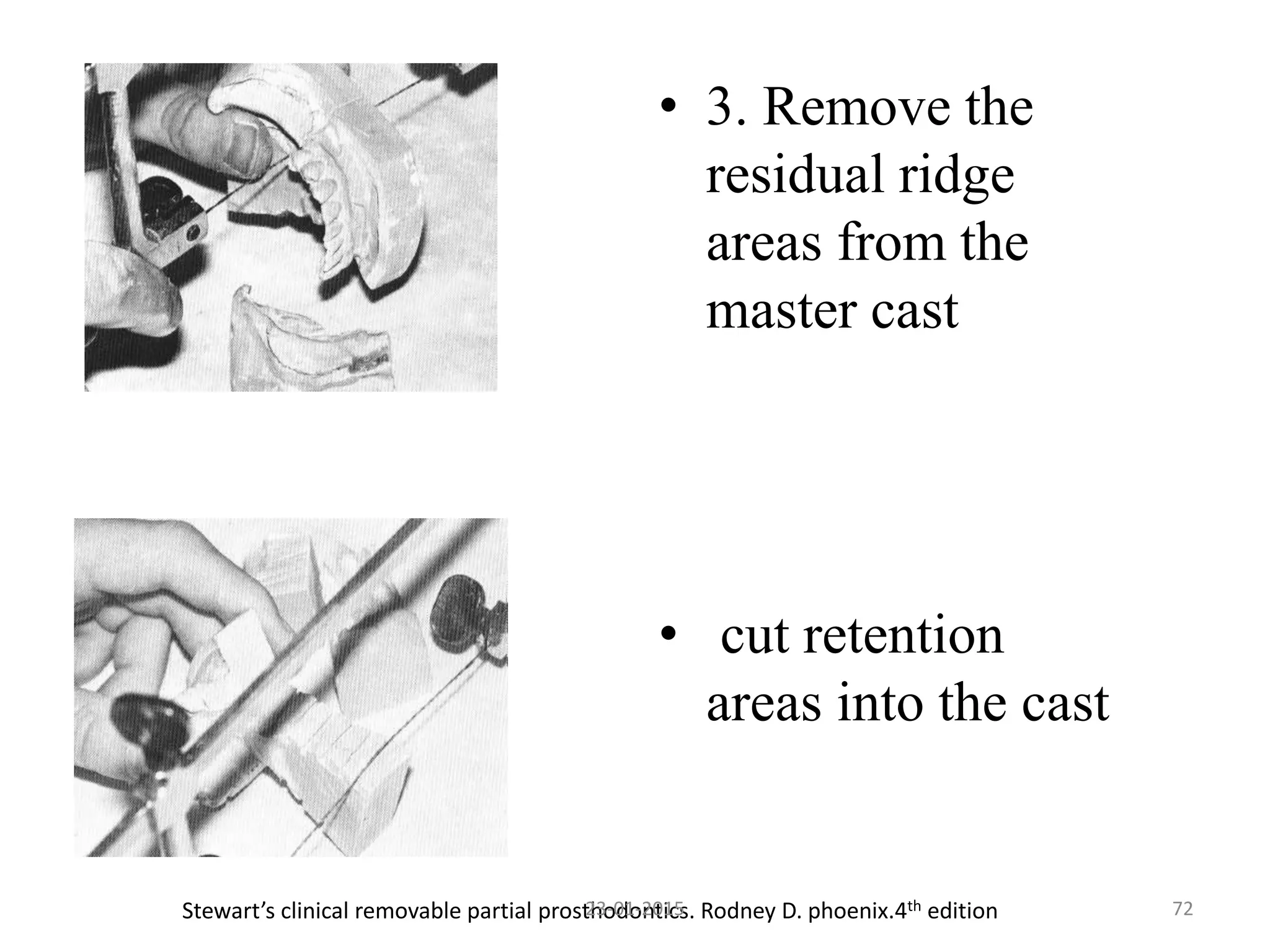 • 3. Remove the
residual ridge
areas from the
master cast
• cut retention
areas into the cast
Stewart’s clinical removable partial prosthodontics. Rodney D. phoenix.4th edition 7223-01-2015
 