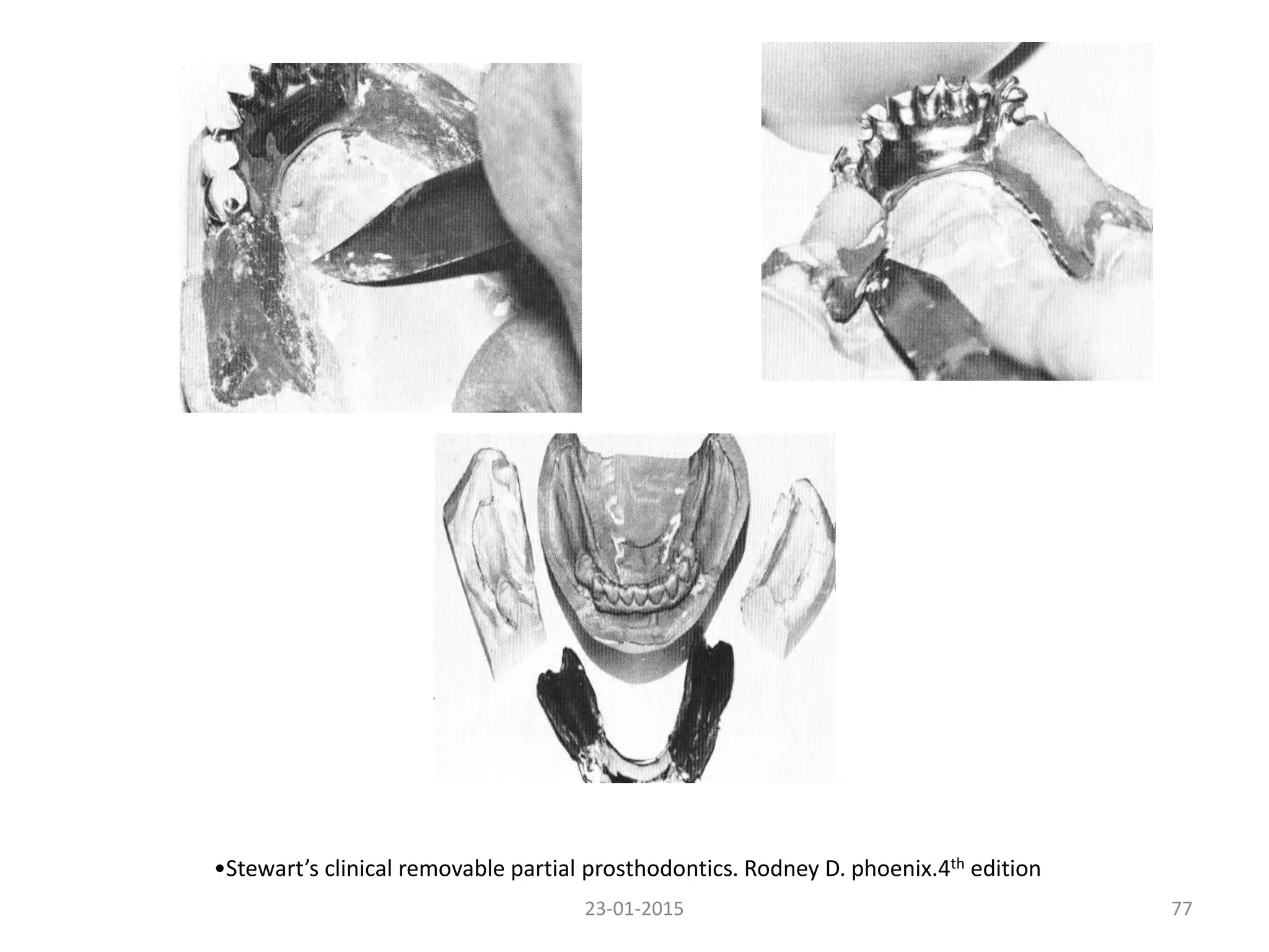 •Stewart’s clinical removable partial prosthodontics. Rodney D. phoenix.4th edition
7723-01-2015
 