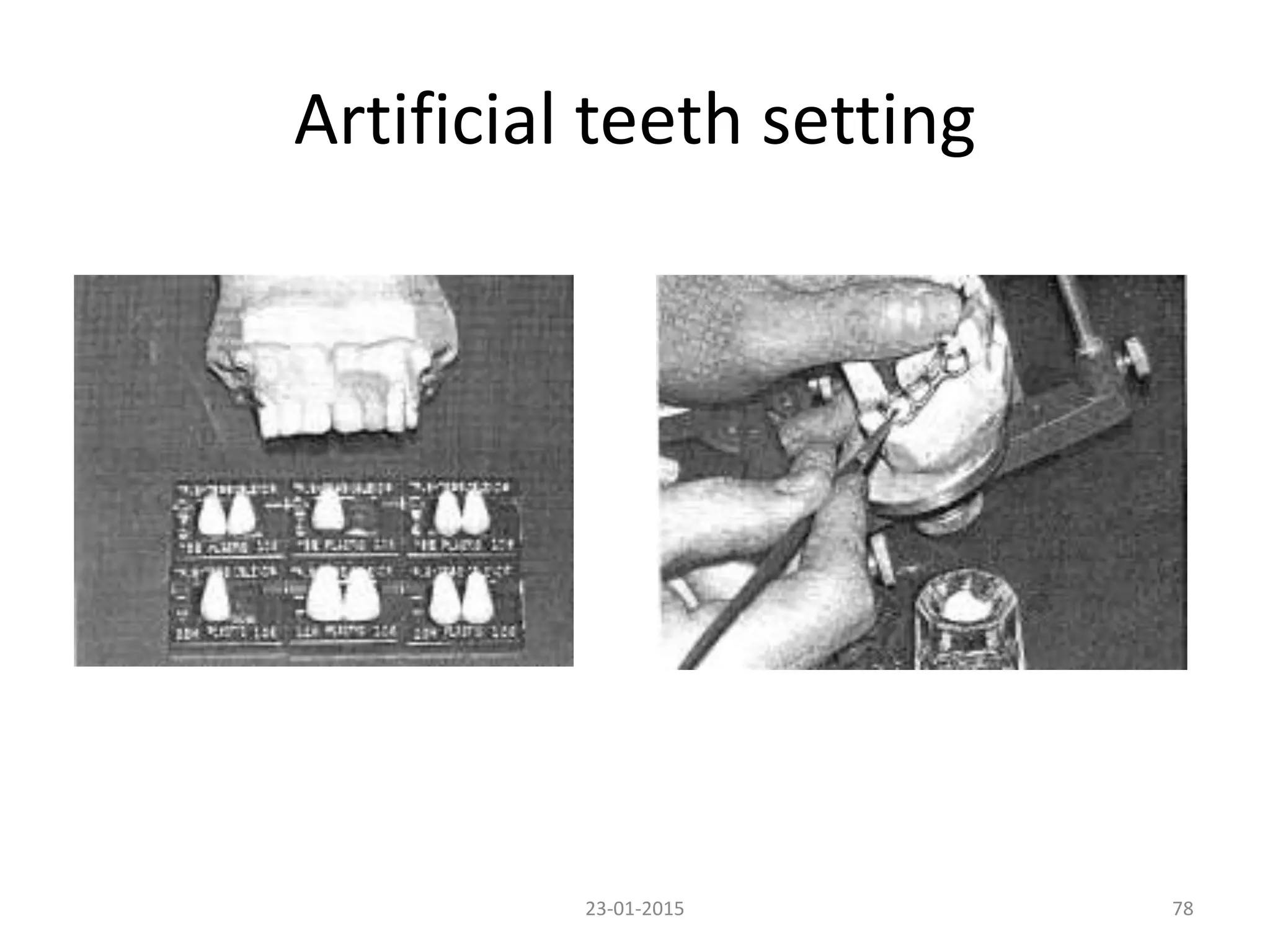 Artificial teeth setting
7823-01-2015
 