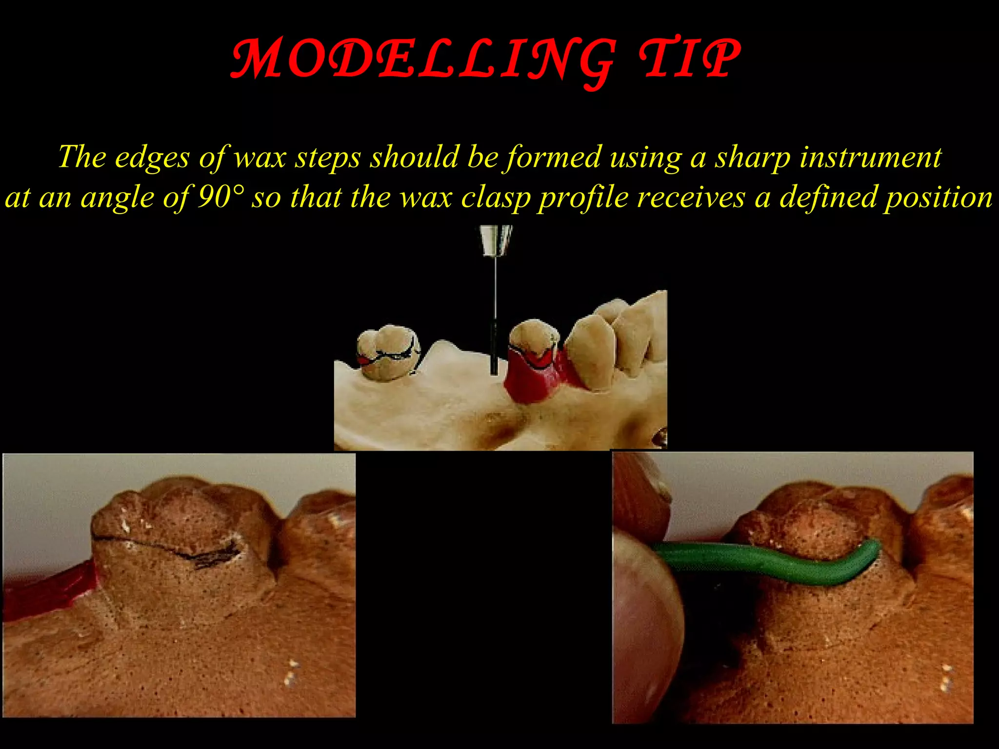 MODELLING TIPMODELLING TIP
The edges of wax steps should be formed using a sharp instrument
at an angle of 90° so that the wax clasp profile receives a defined position
 