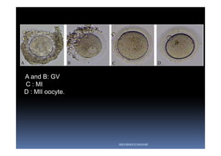 A and B: GV
C : MI
D : MII oocyte.
ABOUBAKR ELNASHAR
 