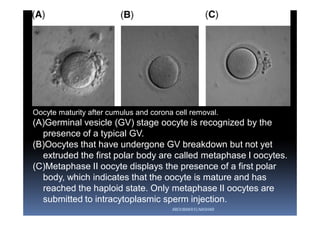 Oocyte maturity after cumulus and corona cell removal.
(A)Germinal vesicle (GV) stage oocyte is recognized by the
presence of a typical GV.
(B)Oocytes that have undergone GV breakdown but not yet
extruded the first polar body are called metaphase I oocytes.
(C)Metaphase II oocyte displays the presence of a first polar
body, which indicates that the oocyte is mature and has
reached the haploid state. Only metaphase II oocytes are
submitted to intracytoplasmic sperm injection.
ABOUBAKR ELNASHAR
 
