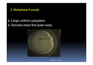 3. Metaphase II oocyte
§ Large uniform cytoplasm
§ Discrete intact first polar body
ABOUBAKR ELNASHAR
 