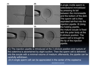 (C) The injection pipette is introduced at the 3 o0clock position and rupture of
the oolemma is ascertained by slight suction. Then the sperm cell is delivered
into the oocyte with a minimal volume of medium; afterwards, the pipette can be
carefully withdrawn.
(D) A single sperm cell can be appreciated in the center of the ooplasma
A.single motile sperm is
selectedand immobilized
by pressing its tail
between the microneedle
and the bottom of the dish.
The sperm cell is then
aspirated tail-first into the
injection pipette. B.Using
the holding pipette,
the mature oocyte is fixed
with the polar body at the
6 o0clock position. The
sperm cell is brought to
the tip of the injection
pipette.
ABOUBAKR ELNASHAR
 
